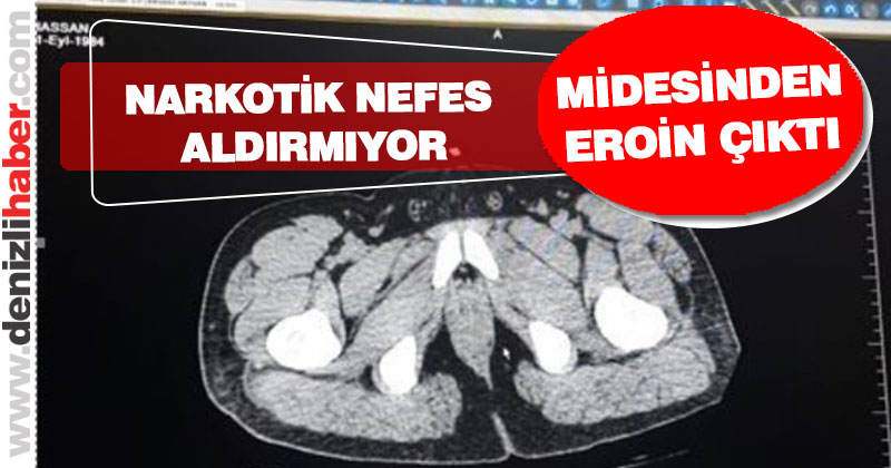 Midesinden eroin çıktı